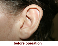 plastic-surgery-prominent-ear 